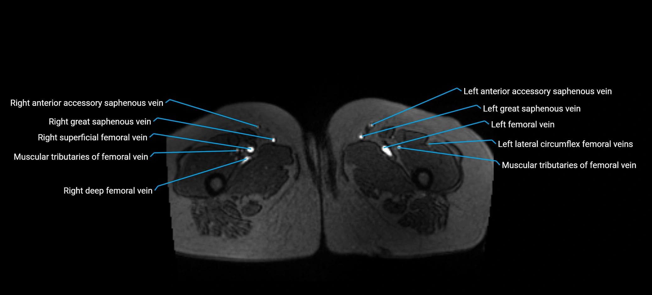 MRV abdomen pelvis & lower limb axial cross sectional anatomy labelled MRI image 218 (1).webp